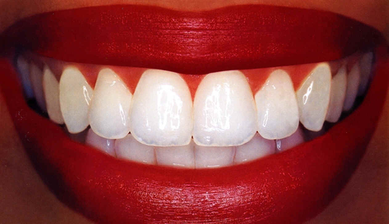How To Get Whiter Teeth Diy Teeth Whitening Get Healthy