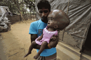 baby with hydrocephalus