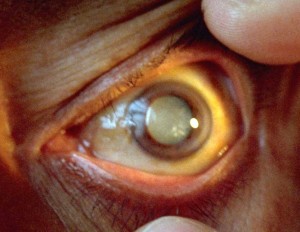 Cataract Peru1