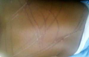 Baby Sahura with strange marks on her back