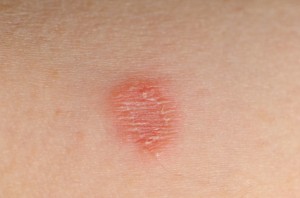 Tinea corporis infection (ring worm)