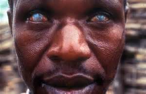 file: man struck with river blindness